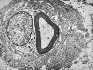 F,23y. | - n.suralis- hypertrophic demyelinizing neuropathy (onion bulbs) F,23y. | - n.suralis- hypertrophic demyelinizing neuropathy (onion bulbs)